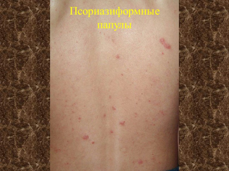 Псориазиформные папулы